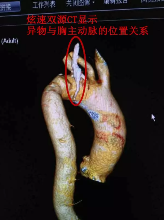 多科联动 围堵穿喉鸭骨